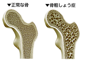 骨粗しょう症