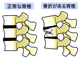 骨折がある脊椎