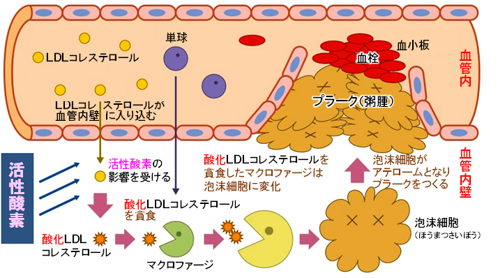 アテローム硬化のメカニズム